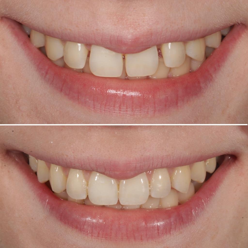 Clear Braces